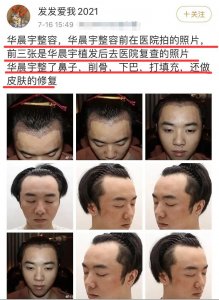 ​华晨宇被曝整容植发，粉丝却称是因皮肤过敏，工作室也起诉了对方